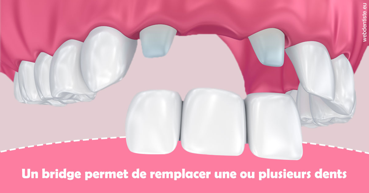 https://selarl-dr-yves-darmon.chirurgiens-dentistes.fr/Bridge remplacer dents 2