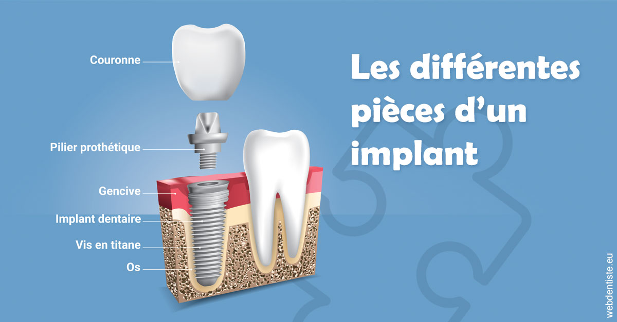 https://selarl-dr-yves-darmon.chirurgiens-dentistes.fr/Les différentes pièces d’un implant 1