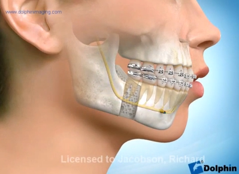 Chirurgie d'avancée mandibulaire