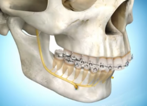 Jaw Surgery (Orthognathic Surgery) Animation - Lower Jaw