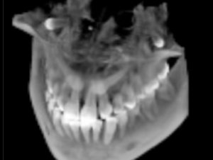 Canines incluses CBCT scan impacted cuspids orthodontie 123213 IT31