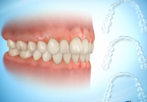 Invisible Aligners and Clear Aligners