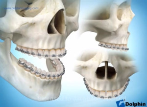 Chirurgie d'avancée du maxillaire supérieur